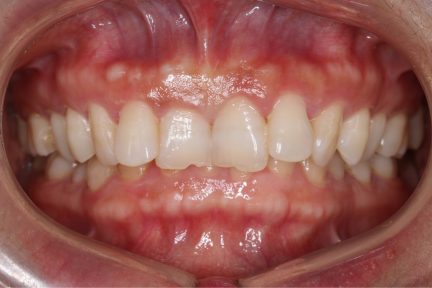Invisalign treatment photo gallery | Invisalign provider